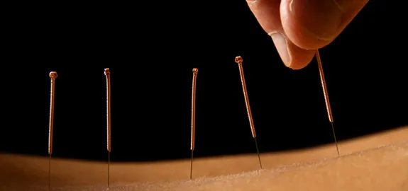acupuncture needles in skin